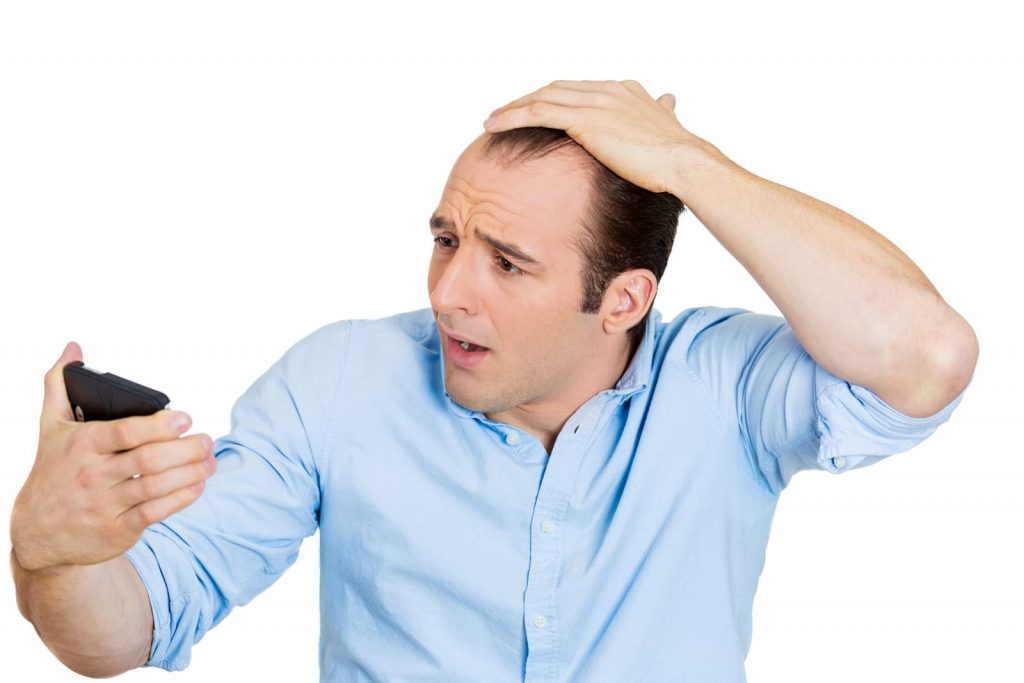 Male Pattern Baldness Male Pattern Baldness