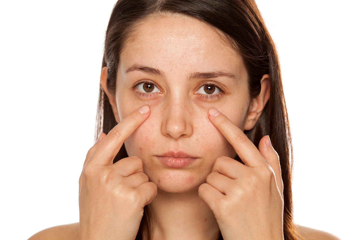 How to Remove Dark Circles Under Eyes