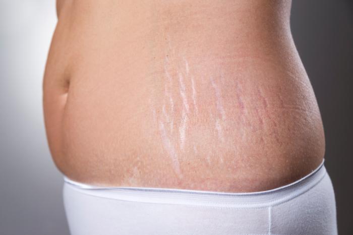 How to Remove Stretch Marks