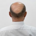 How to Regrow Hair on Bald Spot