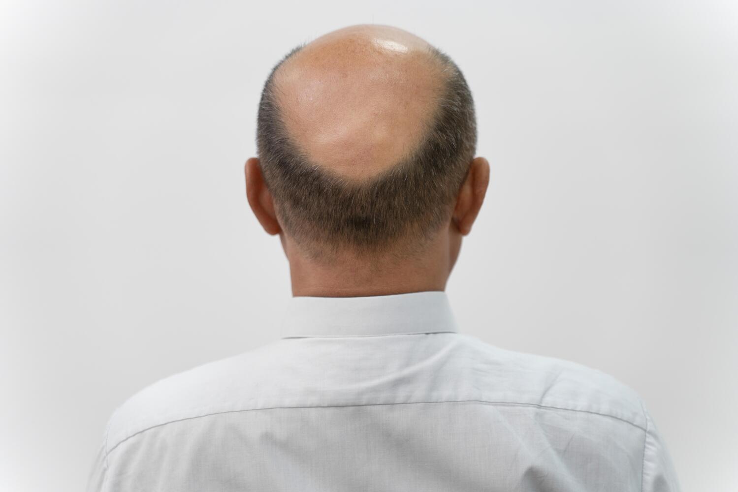 How to Regrow Hair on Bald Spot