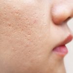 How To Remove Chicken Pox Scars in Adults and Children