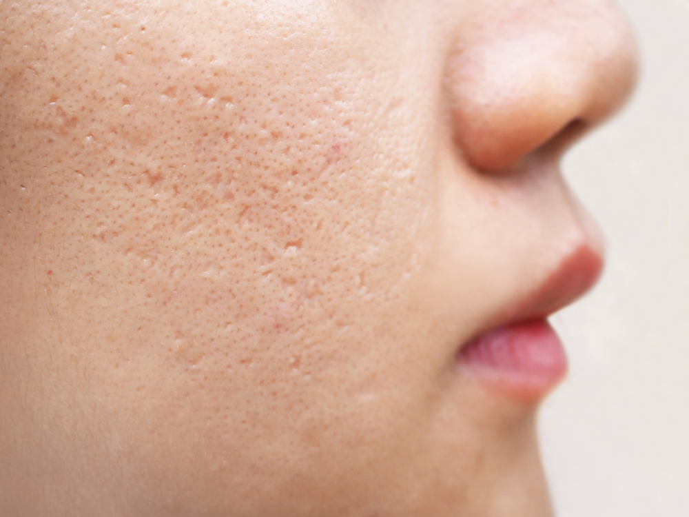 How To Remove Chicken Pox Scars in Adults and Children