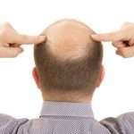 Hair Transplant
