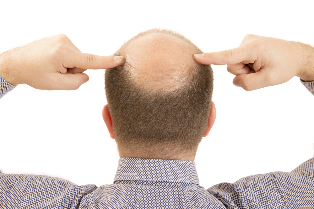 Hair Transplant