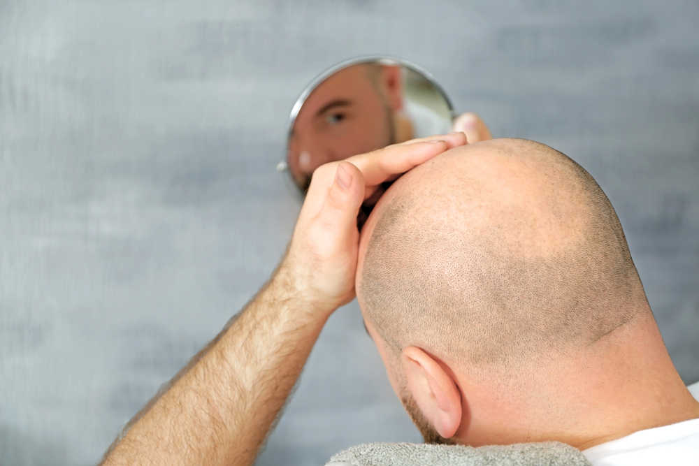 Hair Transplant in Bangalore