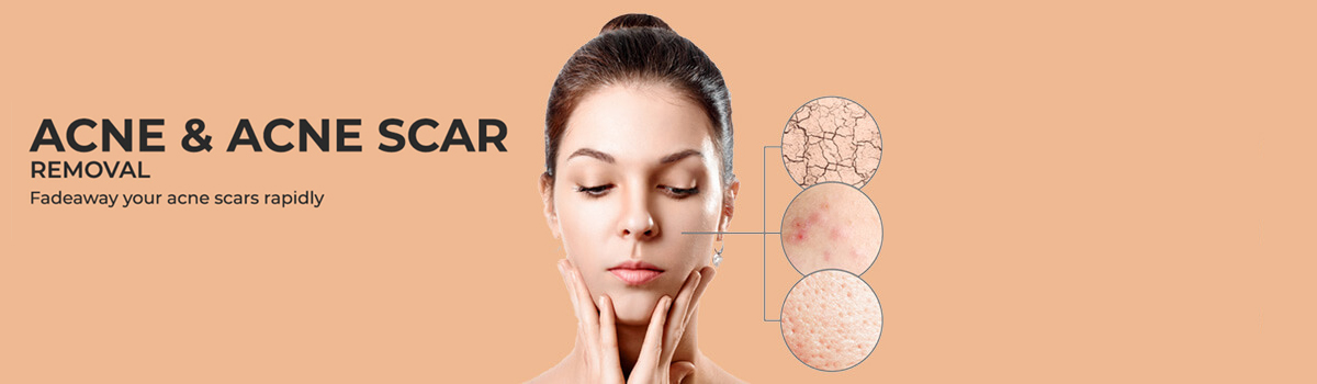 Acne Scar Treatment in Bangalore