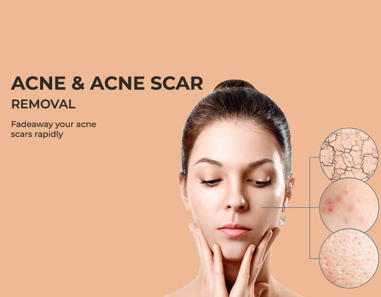 Acne Scar Treatment in Bangalore