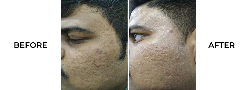 Acne Scar Treatment in Chennai