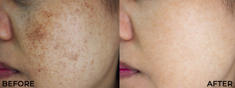 Before and After Dark Spots Removal Treatment