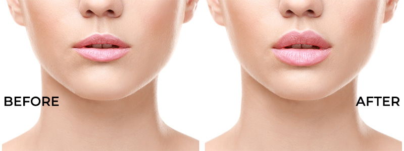Before and After Lip Augmentation