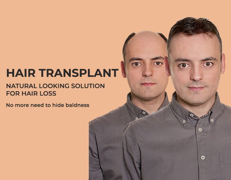 Hair Transplant in Hyderabad