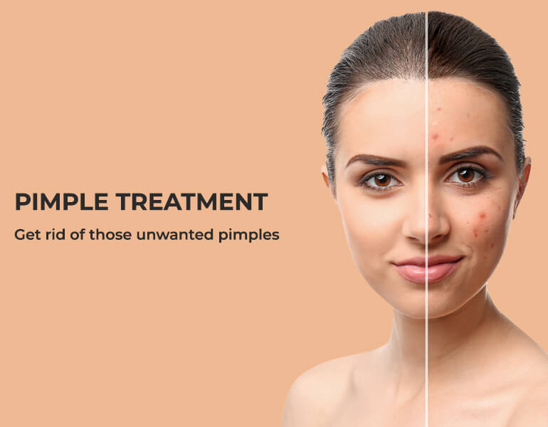Pimple Treatment in Hyderabad