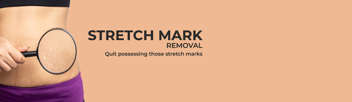 Stretch Mark Removal